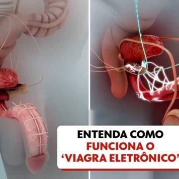 Inovação Médica: Novo Dispositivo Revoluciona Vida Sexual de Homens com Paralisia