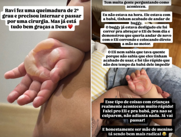 Filho de Viih Tube e Eliezer é internado após queimadura na mão e passa por cirurgia